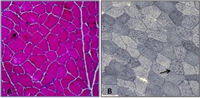 A Family With a Complex Phenotype Caused by Two Different Rare Metabolic Disorders: GLUT1 and Very-Long-Chain Fatty Acid Dehydrogenase (VLCAD) Deficiencies